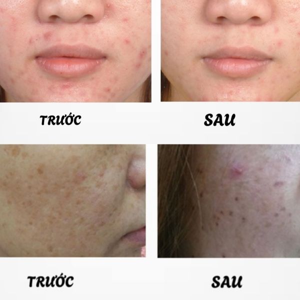 Hình ảnh điều trị máy Laser Spectra XT
