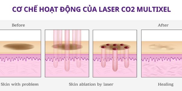 Cơ chế hoạt động của laser multixel