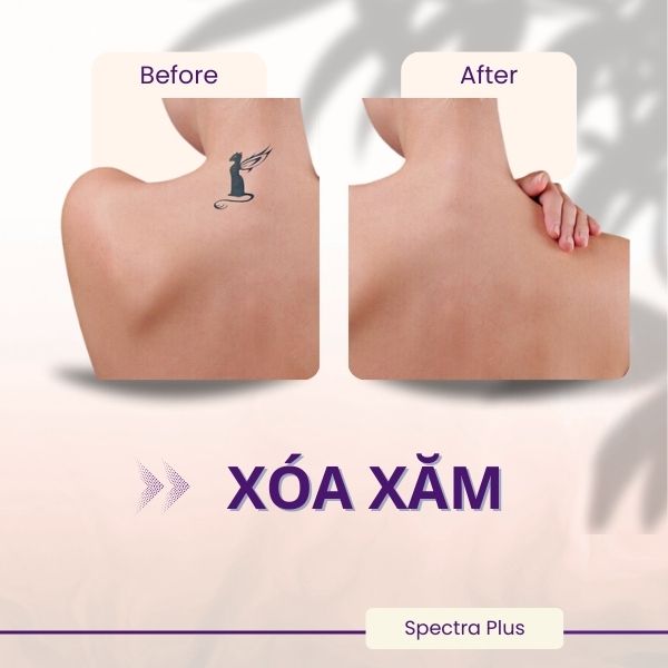 Hiệu quả xóa xăm của Laser spectra plus sau 4 buổi