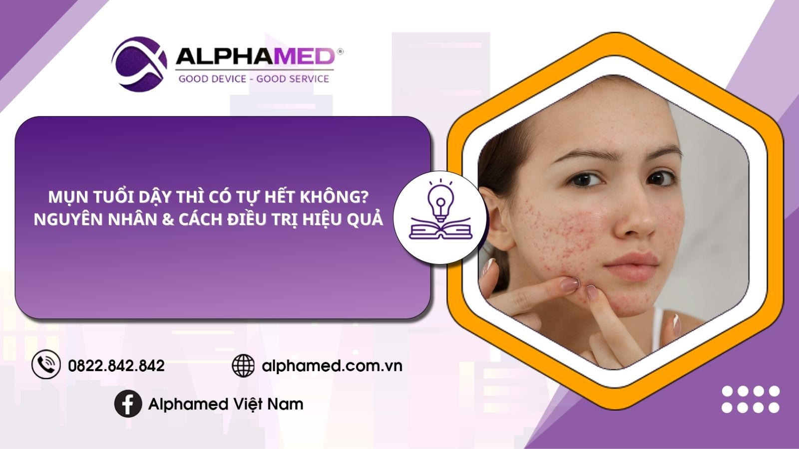 Mụn tuổi dậy thì có tự hết không? Nguyên nhân & cách điều trị hiệu quả