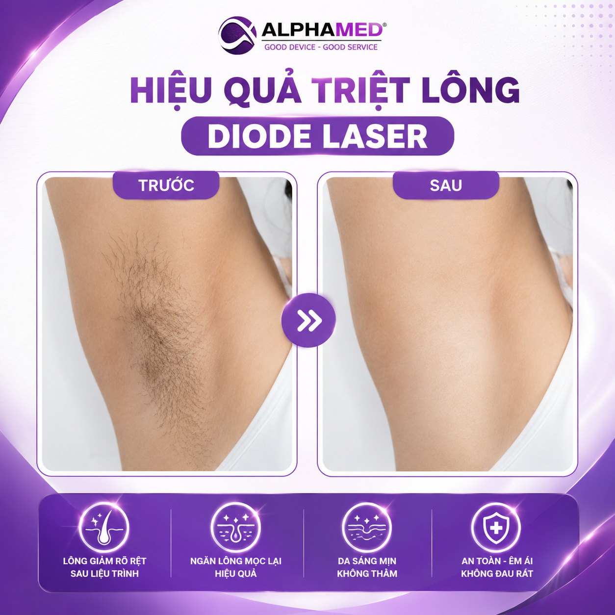 Hiệu quả triệt lông bằng diode laser trước và sau