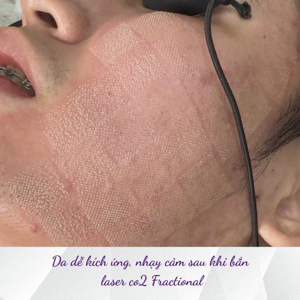 Da sau Laser CO2 Fractional có thể đỏ nhẹ, nóng rát hoặc căng tức trong thời gian đầu. Đây là phản ứng thường gặp và cần được chăm sóc phục hồi đúng cách.