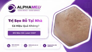 Trị Sẹo Rỗ Tại Nhà Có Hiệu Quả Không? Khi Nào Cần Laser CO2?