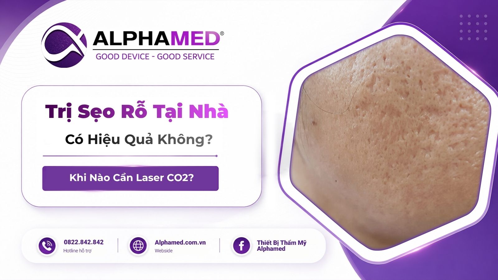 Trị Sẹo Rỗ Tại Nhà Có Hiệu Quả Không? Khi Nào Cần Laser CO2?