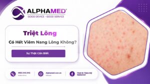 Triệt Lông Có Hết Viêm Nang Lông Không? Sự Thật Cần Biết